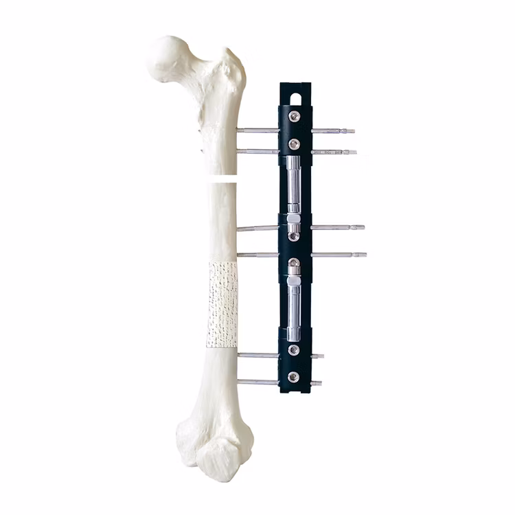 External Fixator Implants